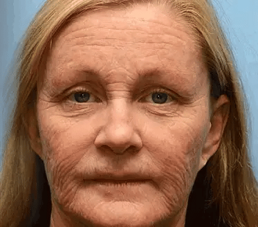 Mayo Clinic Official: AllyBee® Skin Treatment Cream Anti-aging, Hydrating, Skin Repair, Even Tone, Acne and Dark Spot Treatment, Wart and Mole Removal, Psoriasis Relief