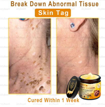 Mayo Clinic Official: AllyBee® Skin Treatment Cream Anti-aging, Hydrating, Skin Repair, Even Tone, Acne and Dark Spot Treatment, Wart and Mole Removal, Psoriasis Relief