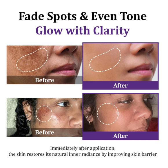 Lovilds Epiglow Melanev Advanced Anti Pigmentation Cream